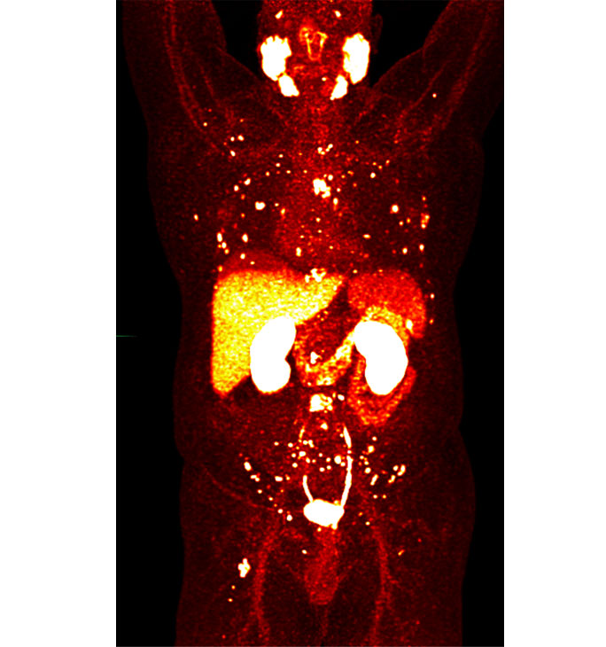 PET Scanning For Prostate Cancer