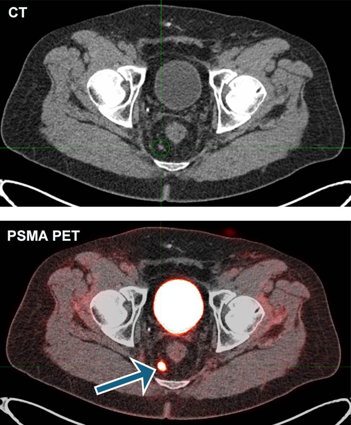 psma-pet-scan-for-prostate-cancer-uchicago-medicine