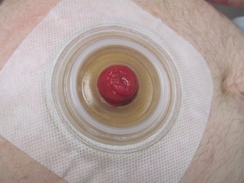 A) Illustrates functional loop ileostomy with stoma bag applied over