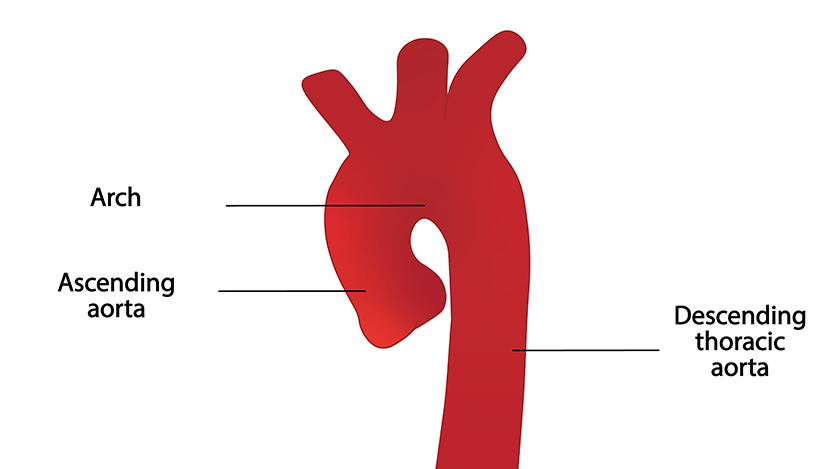 thoracic aortic disruption