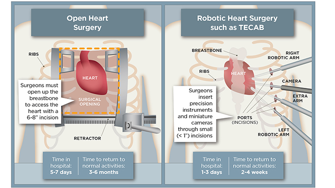 da vinci cardiac surgery