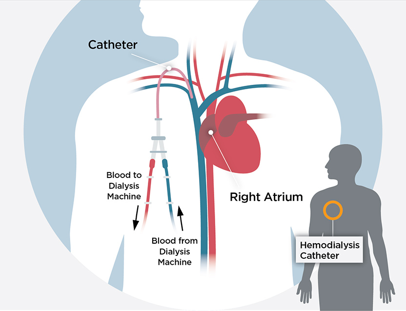 hemodialysis diagram