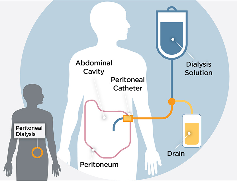 hemodialysis diagram