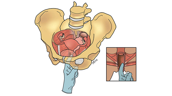 What is pelvic floor therapy? - UCHealth Today