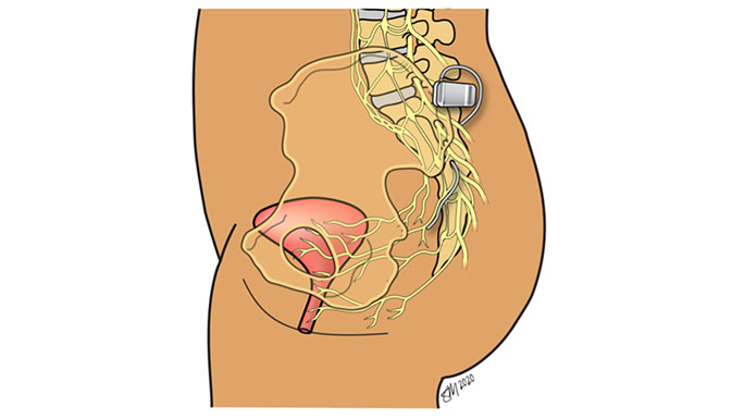 https://www.uchicagomedicine.org/-/media/images/ucmc/adult-images/conditions-and-services/obgyn/urogynecology/sacral-neuromodulation-snm-684x385.jpg