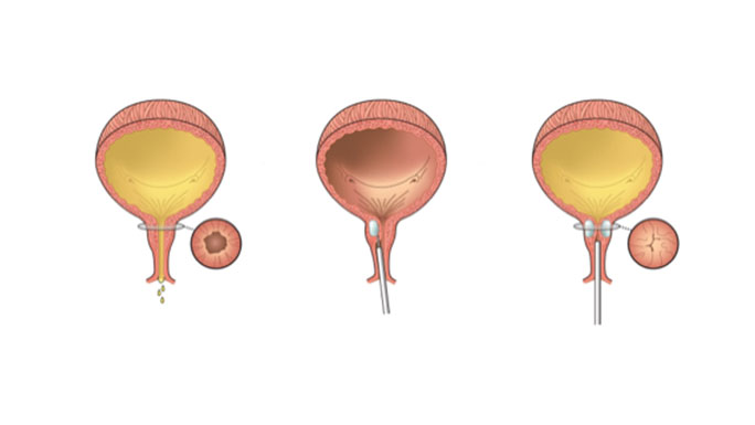 Stress urinary incontinence Information