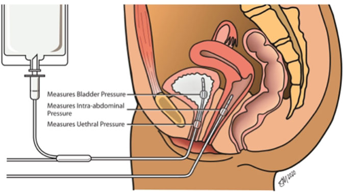 Kegels: The 30-second exercise that can improve incontinence and