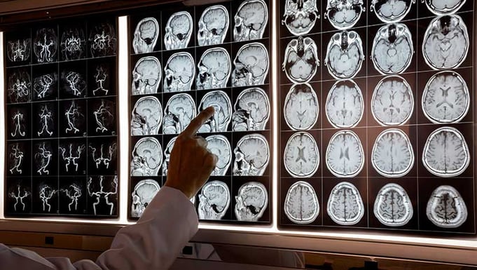 Physician pointing to multiple brain MRI scans