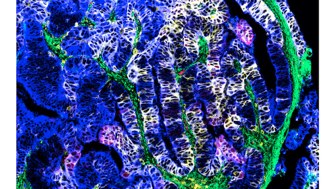 With treatment, tumor cells had more of both HLA-DR and IDO-1 proteins (together shown in yellow), suggesting increased local inflammation and anti-tumor activity. Credit: Sebastiano Battaglia