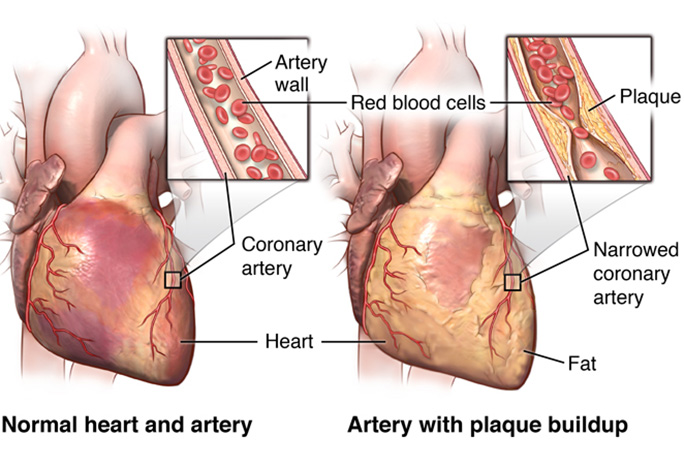 coronary artery disease symptoms