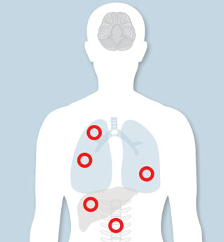 Metastatic Lung Cancer Treatment - UChicago Medicine