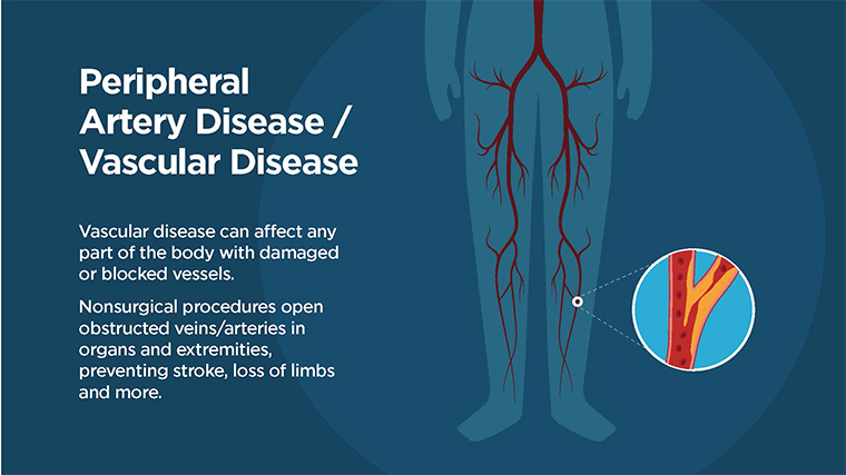 Peripheral Artery Disease: Symptoms, Causes & Treatments - UChicago Medicine