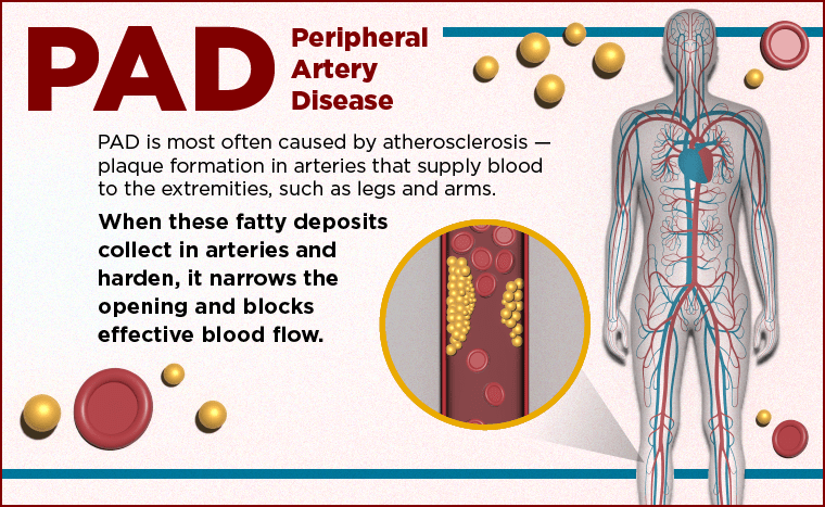 https://www.uchicagomedicine.org/-/media/images/ucmc/module-images/image-slider/heart-and-vascular/pad-infographic/1_pad_infographic_web_v091423.png