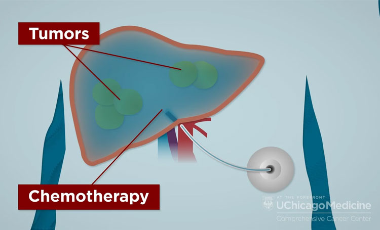 Chemo pump: Definition and how they work