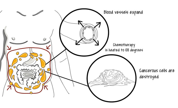 chemotherapy drawing