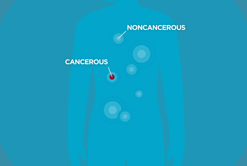 Bone & Soft Tissue Sarcoma - UChicago Medicine