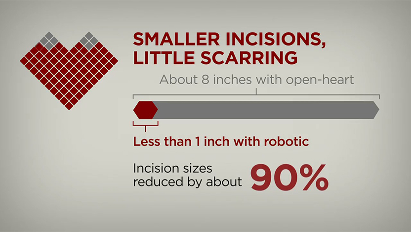 Expert Robotic Heart Surgery Care For Complex Conditions Uchicago Medicine