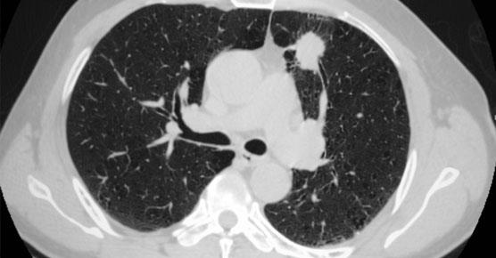 lung cancer on at CT scan