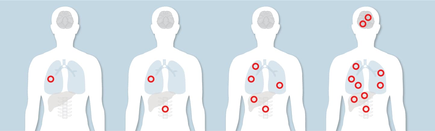how cancer can spread: localized, oligometastatic cancer and widely metastatic