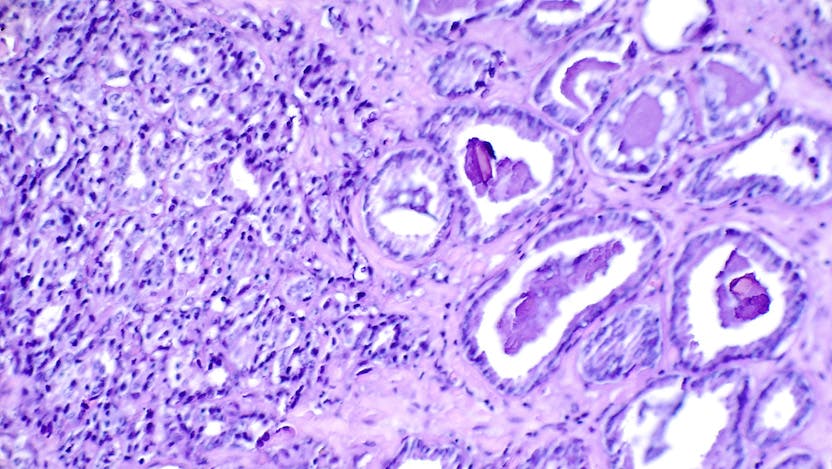 Histological slide showing prostate cancer