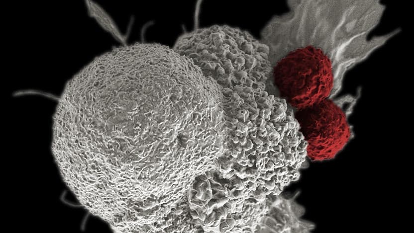 Quadruplet treatment delays the need for stem cell transplantation in newly diagnosed multiple myeloma patients.