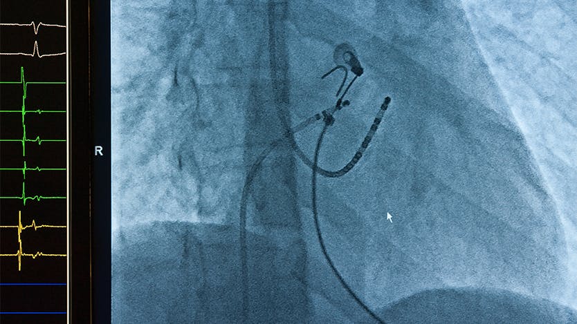 Cardiac ablation for atrial fibrillation