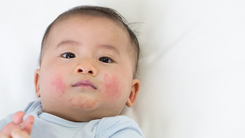 Baby with skin rash