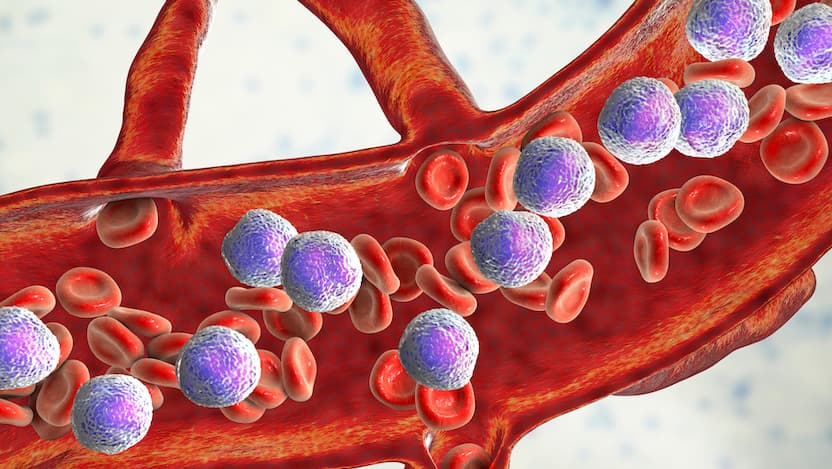 3D illustration showing abundant lymphoblasts in blood