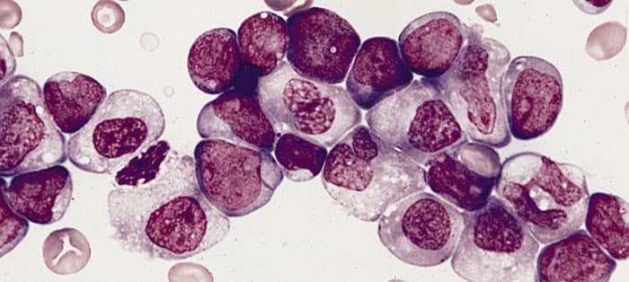 AML cells