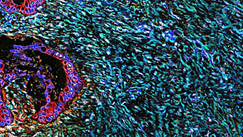 Pancreatic cancer causes the connective tissue around the tumor to thicken and scar. Cancerous cells are in red; nuclei are in blue; Fibrous connective tissue is in cyan. (Credit: Fox Chase Cancer Center, National Cancer Institute, National Institutes of Health)