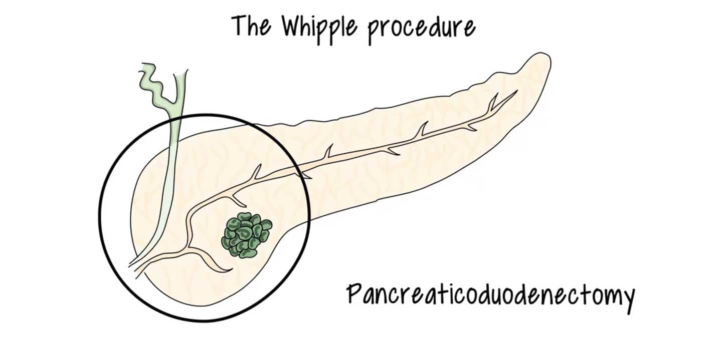 illustration of the Whipple procedure